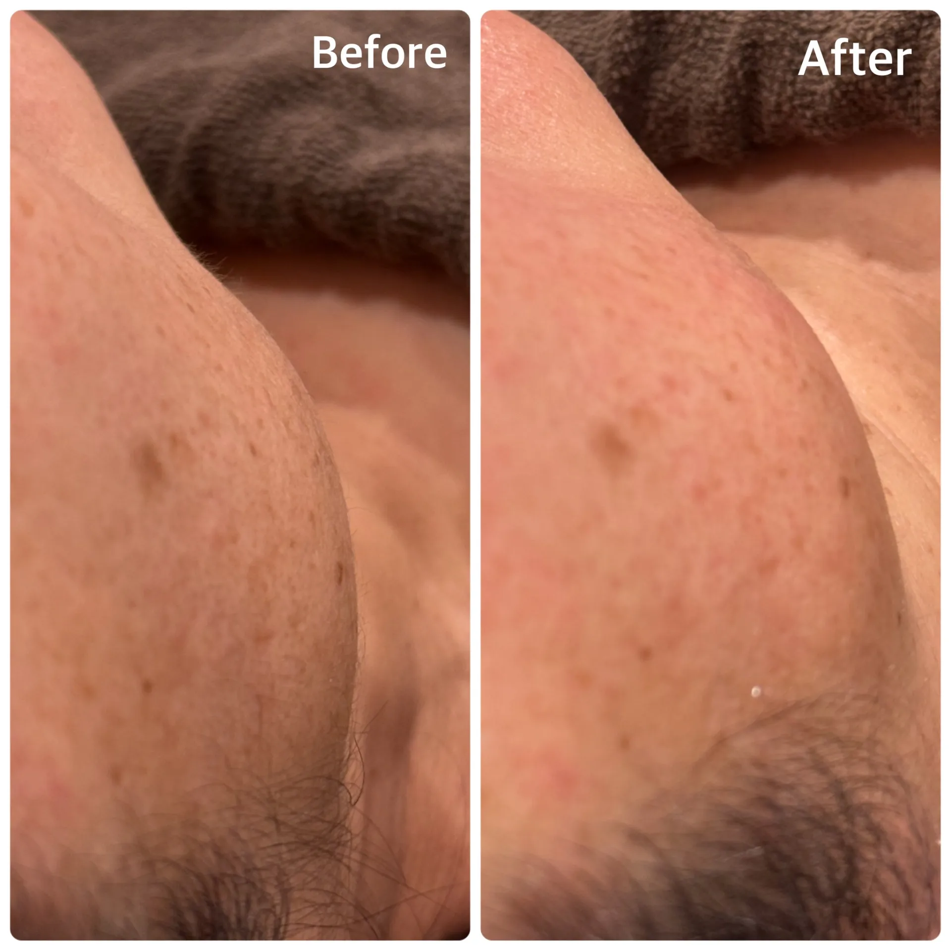 産毛脱毛は、マツヤニワックスを！